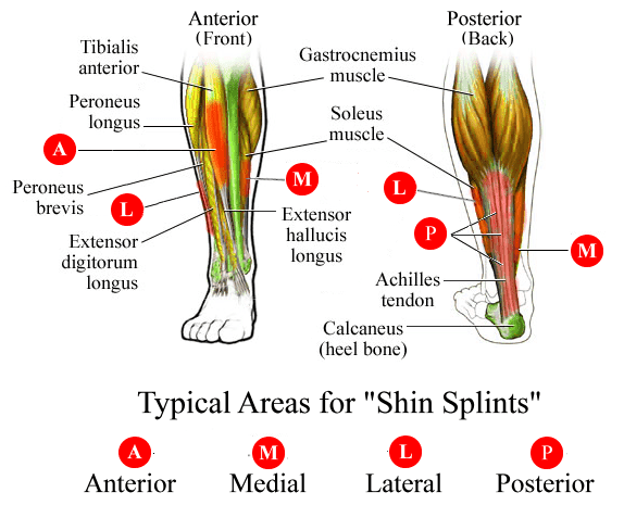 Shinsplints