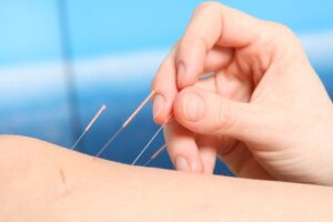 Acupunctuur fibromyalgie