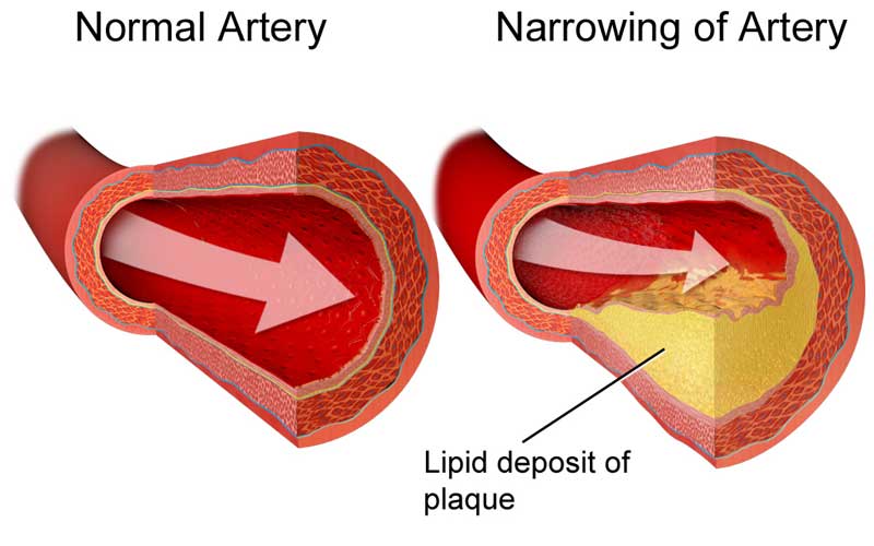 Cholesterol