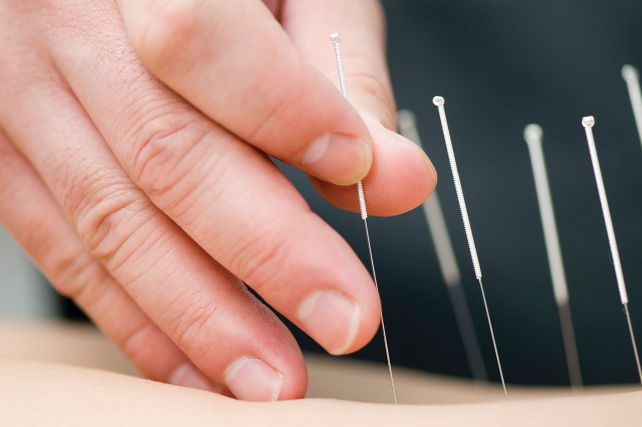 Dry-Needling