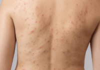 Acne Vulgaris