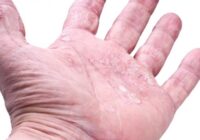 Acrovesiculeus eczeem