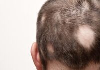 alopecia-areata